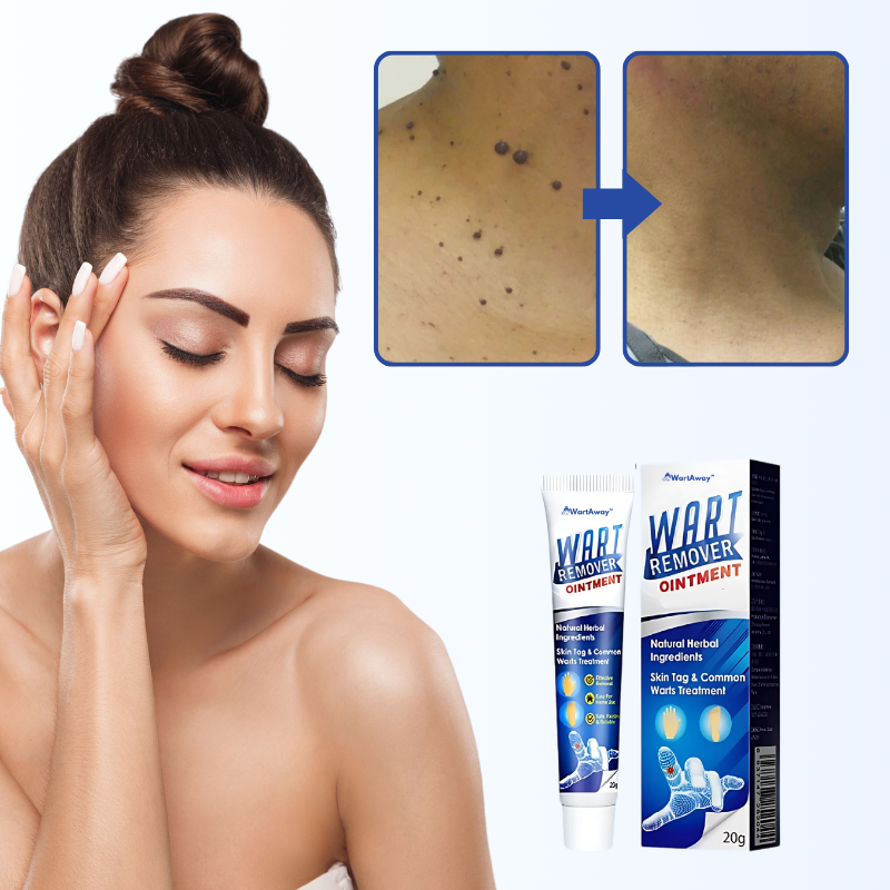 WartAway™ Crème